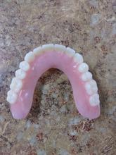 Acrylic horseshoe denture