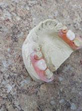 Flexible Custom Nesbit Denture
