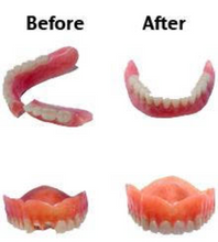 Load image into Gallery viewer, Chipped Denture Repair Custom False Teeth
