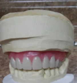 Horsheshoe U-Shape Custom Denture